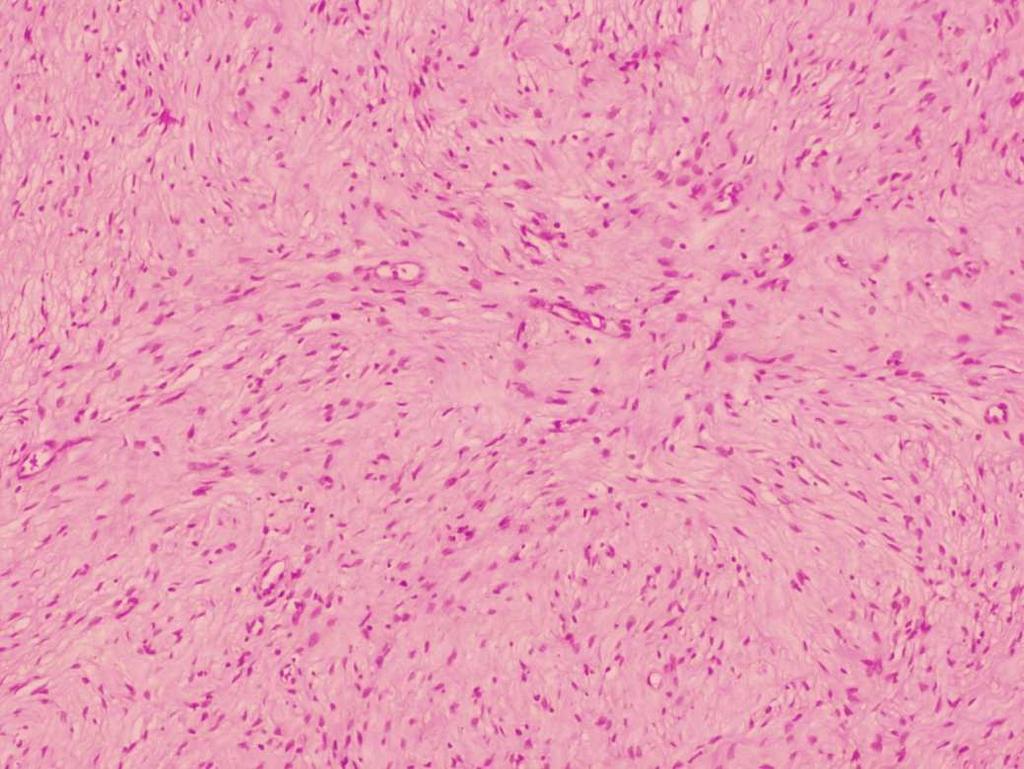 233 234 235 236 Figure 5: Microscopic image: Hematoxylin and eosin staining revealed spindle cell proliferation with a palisading pattern (magnification, x10) 237 238