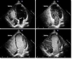 Provocative Testing Stress contrast echocardiography - Greater diagnostic accuracy - Regional wall motion abnormalities - Asymptomatic ventricular dysfunction - Data regarding diagnostic accuracy of