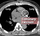 Provocative Testing Computed tomography coronary angiogram (CTCA)/Coronary calcium score - Information on the vascular lumen and the arterial wall - Reduced sensitivity and specificity in diabetic