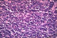 CTCL is a neoplastic amplification of skin honing T cells characterized by triad of skin localization, avoidance of bone marrow and infiltration of perifolliculartcell zones of lymphnode and spleen.