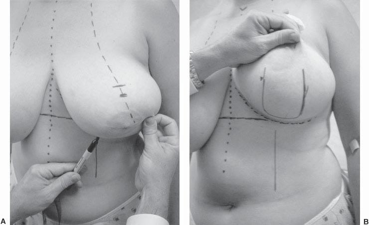 206 SEMINARS IN PLASTIC SURGERY/VOLUME 18, NUMBER 3 2004 Figure 1 (A) Midline, breast meridian, transposed inframammary fold, and position of new nipple/areola are marked first while patient is