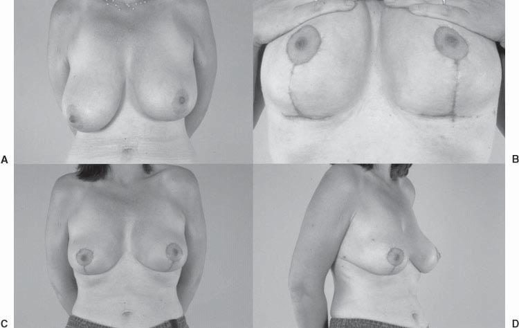 SUMMARY There are multiple advantages to performing breast reduction using the superomedial pedicle technique.