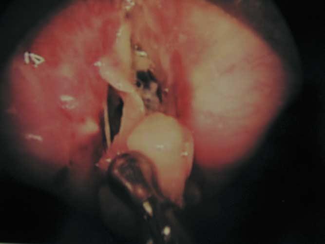 Hueman and Simpson Airway Complications From Topical Mitomycin C 833 Figure 1 Intraoperative view of obstructing fibrinous exudates.