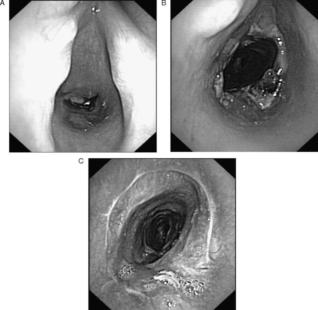 820 A.M. Ciccone et al. / European Journal of Cardio-thoracic Surgery 26 (2004) 818 822 of airway stenosis.