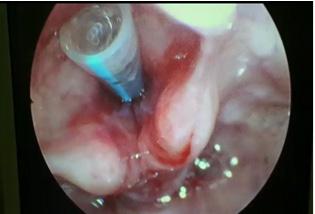 54 Case Series Fig. 4. Endotracheal tube number 4 inserted after LASER assisted release of stenosis patient was admitted in view of neuroparalysis secondary to snake bite 2 months back.
