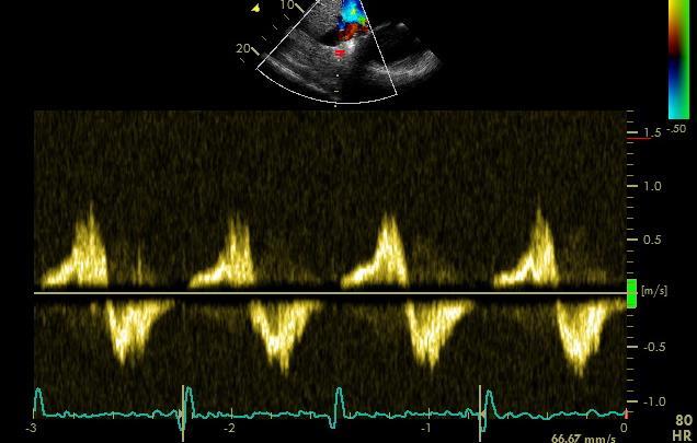 Holosystolic hepatic vein flow reversal is diagnostic of severe TR, although if the