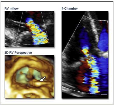 3D Echocardiographic Location of Implantable Device Leads and Mechanism