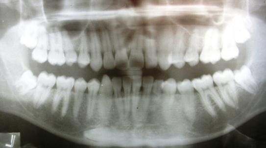 completely edentulous. The panoramic radiograph indicated the left mandibular canine was impacted mesioangularly with part of crown crossing the midline.