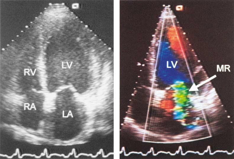 Mitral-Valve Prolapse A B Idiopathic Dilated Cardiomyopathy C D Figure 2.