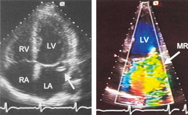 The man with prolapse (Panels A and B) has severe mitral regurgitation (MR), a partial flail posterior leaflet (arrow in Panel A), a normal-sized left ventricle (LV), normal systolic function