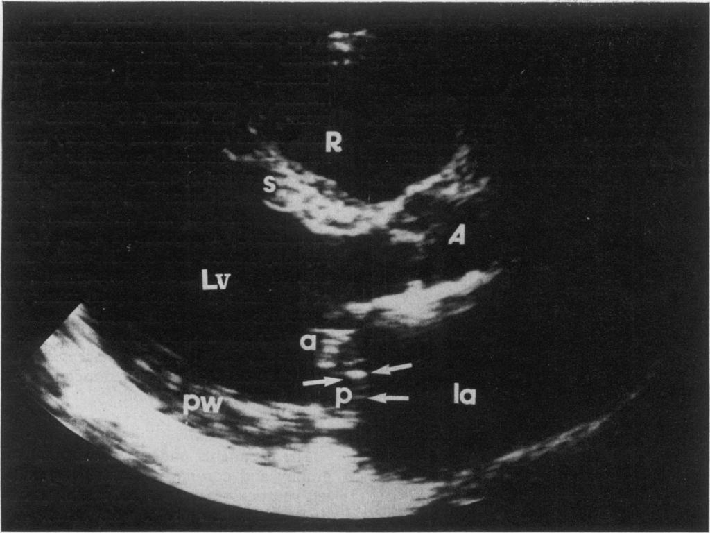 260 R. M. Donaldson et al. FIG. 3. Long axis view from the patient with severe mitral regurgitation from ruptured chordae tendineae and flail posterior mitral leaflet.