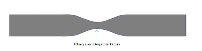Figure 1 shows the simple geometry of the artery with plaque deposition. Fig.