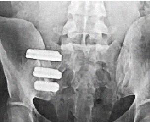 Patient Profiles The following patients have graciously given permission to present their personal experiences regarding SI joint problems and subsequent surgery with the ifuse Implant.