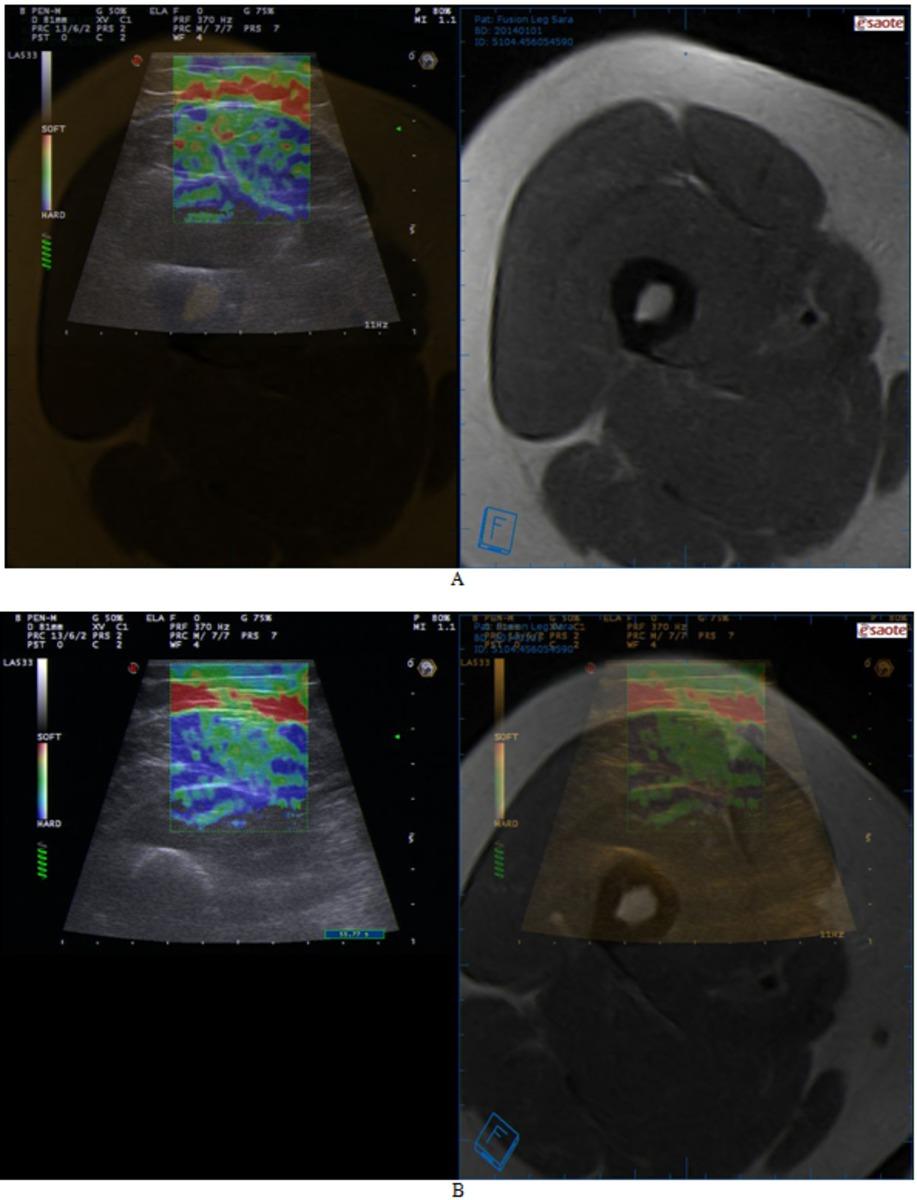 Fig. 9: Real-time Sonoelastography performed after fusion imaging between MRI and