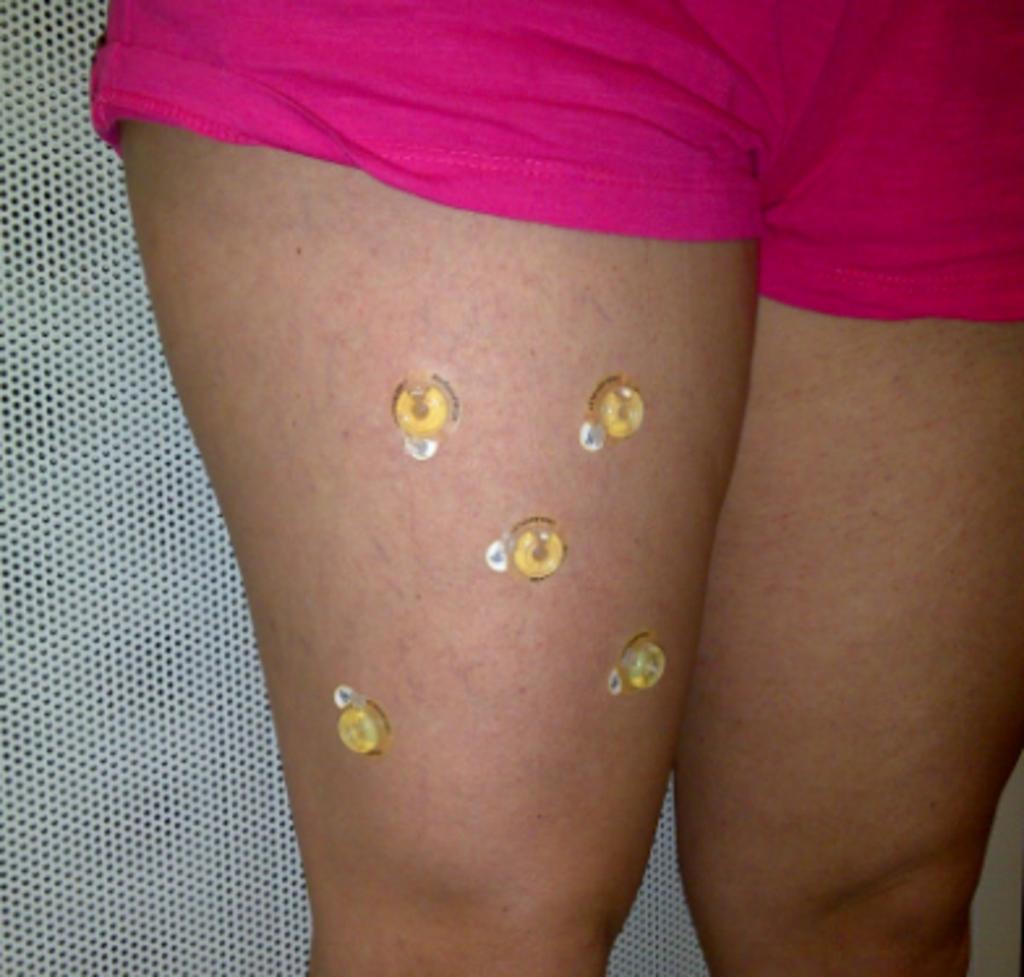 Fig. 3: Five (5) pinpoints were applied on the leg since there are no