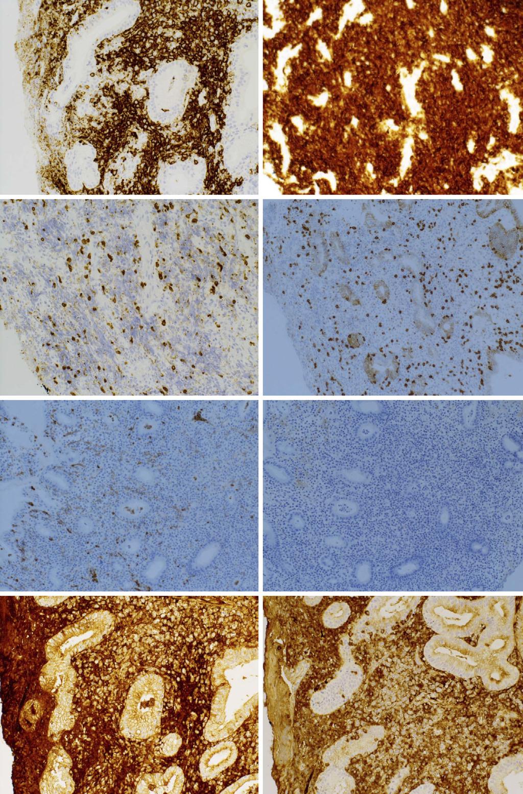 c d e f g h 100 Figure 4. Immunohistochemistry of the iopsy specimen otined from the ulcerted lesion.