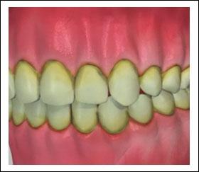 Discoloration starts with any tint or white streak on the teeth.