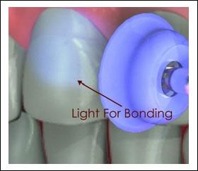 Composite bonding: In this procedure, plastic material or resin material which matches the color of the tooth is
