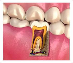 2) Root is the part of the tooth which is inside the