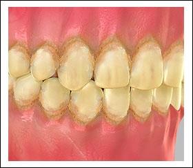 Unit 2: TOOTH DISCOLORATION Overview of Tooth Discoloration What is Tooth Discoloration? Tooth Discoloration is any change in color and translucency of the tooth due to any cause.