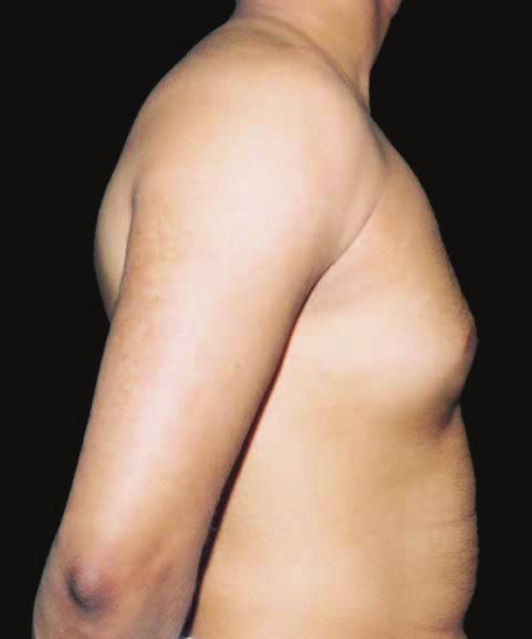 Figure 1. Gynecomastia classification. A, Type 1: enlarged breasts with elastic skin and no fold., Type 2: enlarged breasts with elastic skin and an inframammary fold.