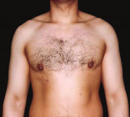 E Figure 2. A,, E, Preoperative views of a 29-year-old man with type 1 gynecomastia.,, F, Postoperative views 18 months after surgery.