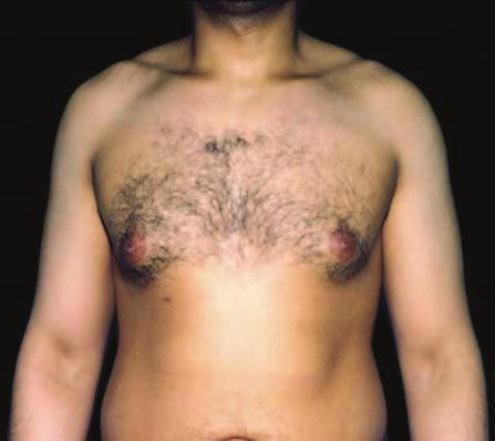 arm in a type 3 patient. F ISUSSION There appears to be no relationship between the type of gynecomastia and patient age, duration of gynecomastia, or breast size or contents.