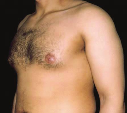 techniques followed by removal of a marginal rim of subcutaneous fat by surgery or lipoplasty. Treatment of gynecomastia with UAL alone was found to result in a high percentage (41.