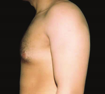 arms at their sides during surgery, and having patients wear medical-grade compression vests for a period of 3 months after treatment. The causes of residual gynecomastia require further elucidation.