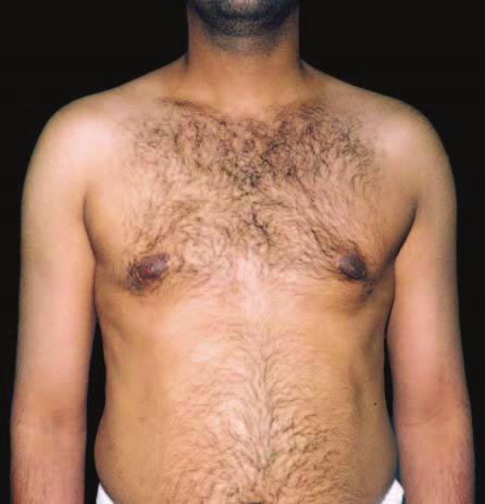 E Figure 3. A,, E, Preoperative views of a 25-year-old man with type 2 gynecomastia.,, F, Postoperative views 6 months after surgery.