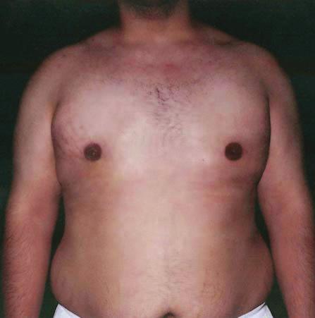 E Figure 4. A,, E, Preoperative views of a 23-year-old man with type 3 gynecomastia.