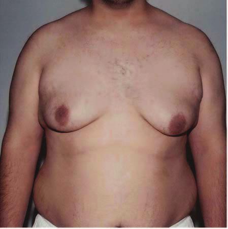 Some existing surgical techniques, such as the inverted-t technique, result in scars on the anterior chest.