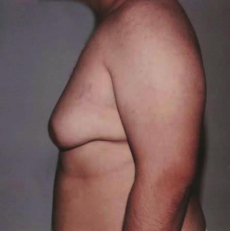 gynecomastia, persistence of an IMF sharply demarcating the chest from the abdomen, persistence of loosely hanging breast skin,