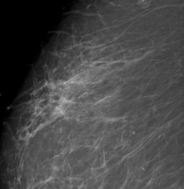 NON-CALCIFIED ASYMMETRIC DENSITIES WITH architectural distortion on the mammogram.