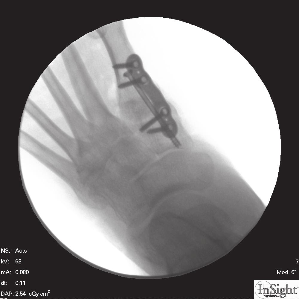 Mobilisation of the first metatarsophalangeal joint, corrective bandaging and hallux