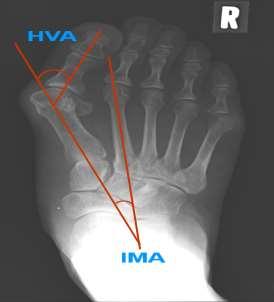 Patients and methods From 2007 to 2010, DLMO was undertaken in our department independently by the same surgeon on 30 patients with mild-to-moderate hallux valgus deformity (42 feet; 2 males, 28