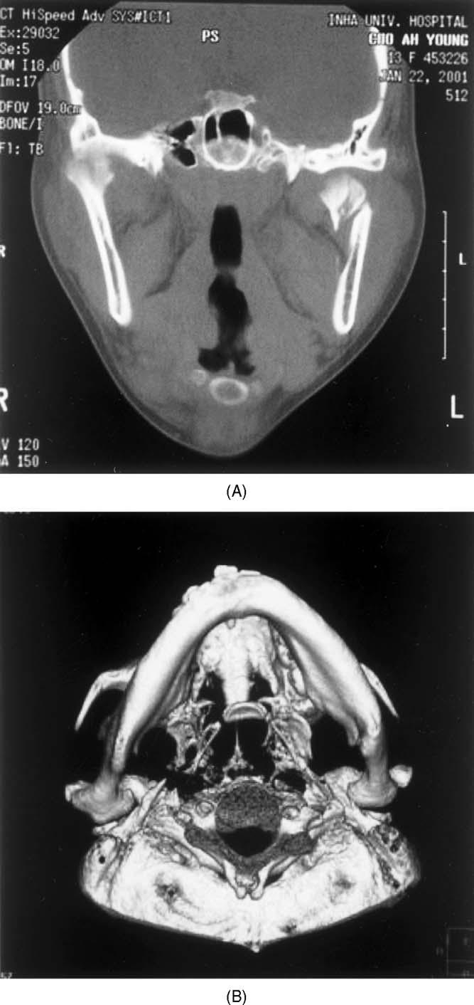 A follow-up study of condyle fracture in children 855 Fig. 4. TMJ images of a 15-year-old female who sustained left high condyle neck fracture at the age of 13.
