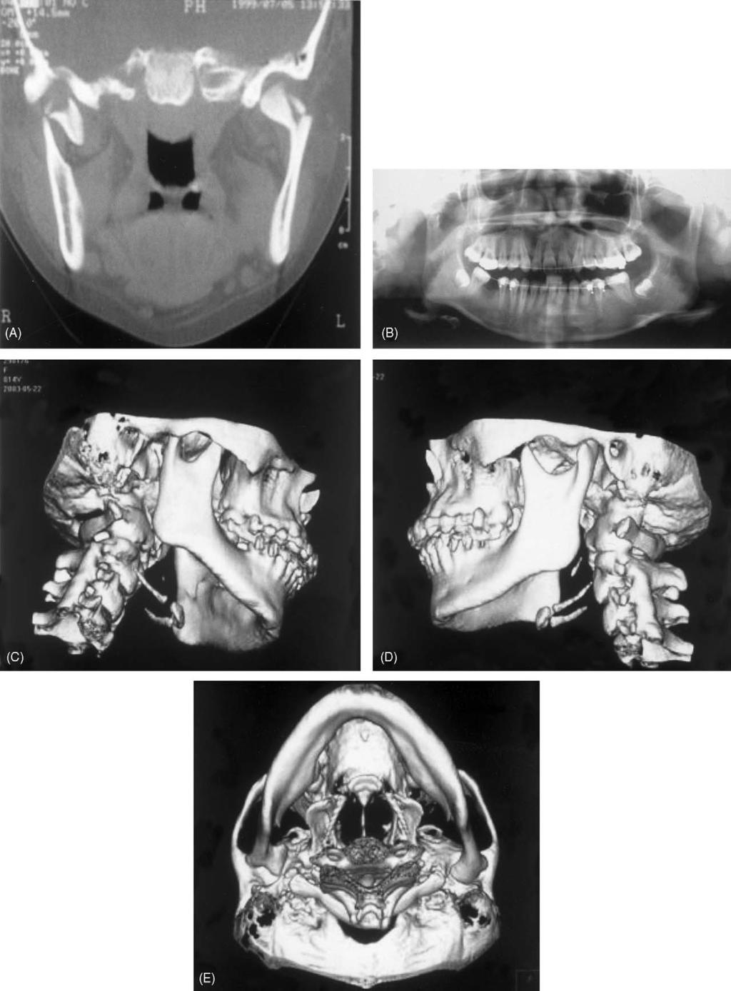 856 Choi et al. Fig. 5. TMJ images of a 15-year-old female who sustained a dislocated high condyle neck fracture of the right and displaced high condyle neck fracture of the left at the age of 11.
