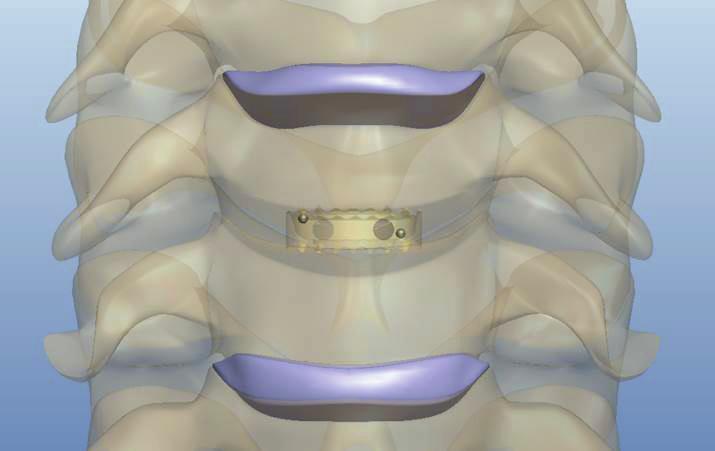 SURGICAL TECHNIQUE 6. Implant Positioning: Verify the final ACIF Implant position relative to the vertebral bodies in the AP and Lateral directions with the help of an intraoperative x-ray.