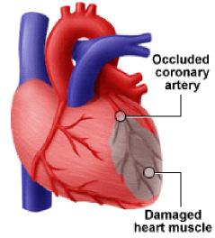 Cardiovascular Diseases in Diabetes The Cardiovascular Disease Triad Cardiovascular diseases that accompany diabetes are: Angina Heart attack Stroke Periphery artery Disease Congestive heart disease