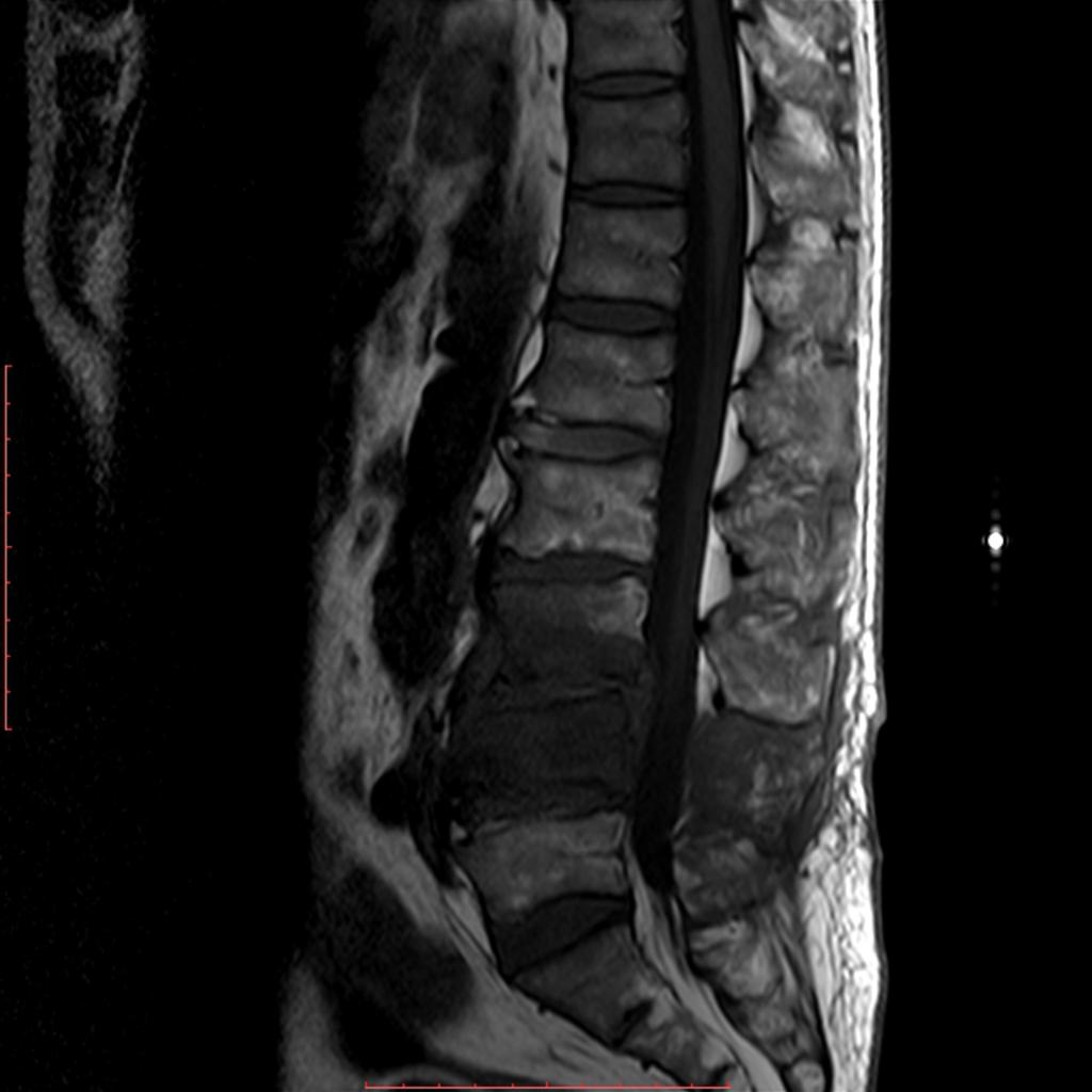 Fig. 8: MRI, T1wI, lumbar spine, sagittal plane, of a 60 year-old man with pyogenic spondylodiscitis, showing pathologically low signal in