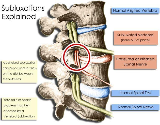 Vertebral Subluxation- This interferes with the flow of mental impulses- which results in atrophied or dead tissue cells.
