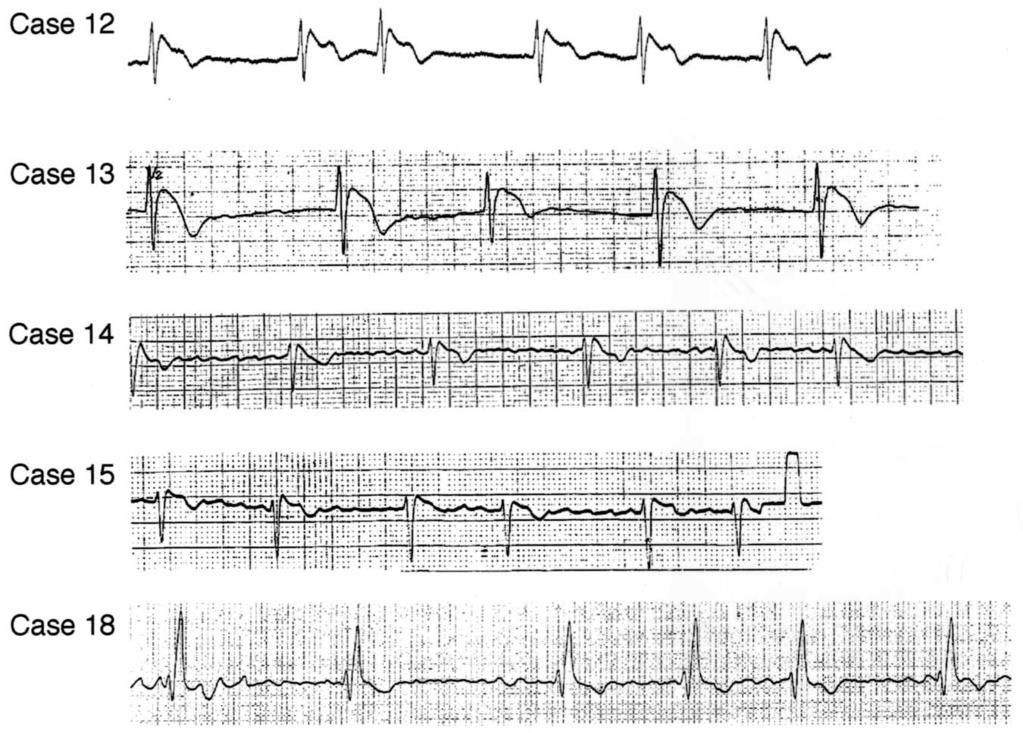 1440 Morita et al. JACC Vol. 40, No. 8, 2002 AF in Brugada Syndrome October 16, 2002:1437 44 Figure 2. Spontaneous atrial fibrillation (AF) in patients with Brugada syndrome.
