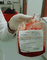 Umbilical Cord Blood Transplantation (UCBT) 1982 UCB might contain sufficient HSC to reconstitute lymphohaematopoiesis 1988 1993 1993