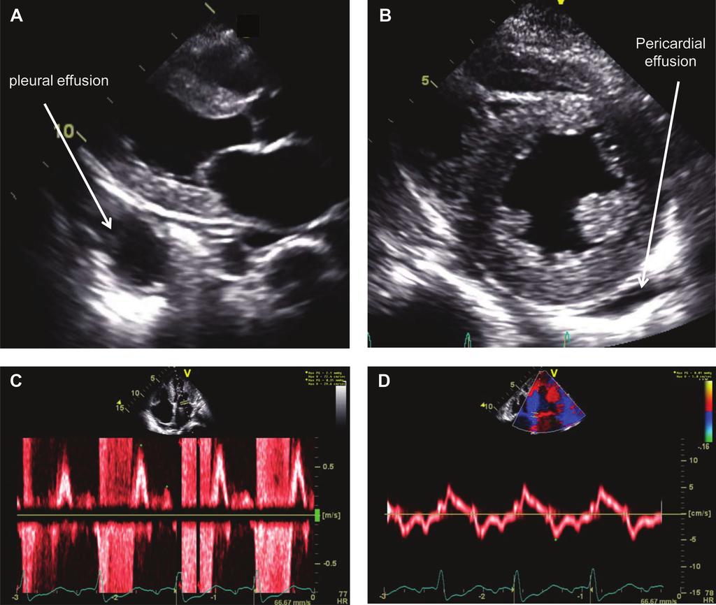 Ruberg and Berk Transthyretin Cardiac Amyloidosis 1291 Figure 5. Echocardiographic appearance of V122I transthyretin cardiac amyloidosis (ATTR).