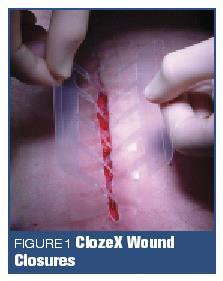 Wound Closure 3M skin closure device Breathable polyurethane, latex-free Not to be used over joints unless immobilized.