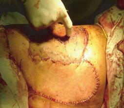 wall. Fig 5: Flap insetting done & donor defect covered with skin graft.