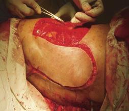 enlarged, tense, congested left breast with surface ulceration, for 3 months.