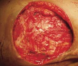 Management of recurrent phyllodes with full thickness chest wall resection smelling discharge, at the operated