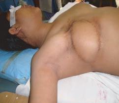 She was treated with wide local excision and latissimus dorsi flap reconstruction of chest wall followed by